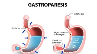 Gastroparesis: Dysfunction of Vagus nerve, symptoms, Diagnosis and possible treatment