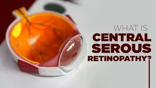 What is Central Serous Retinopathy | Symptoms, Prevention, Treatment and More