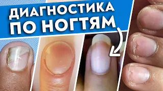 Как определить болезнь по ногтям? | Ногти скажут всё о вашем здоровье!