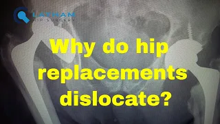 Why do hip replacements dislocate?