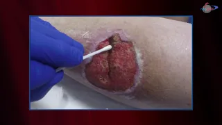 WCW: Follow Up - Managing a Trauma Induced Lateral Leg Hematoma