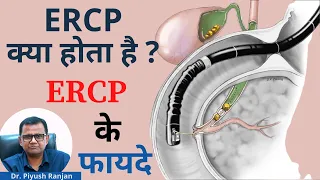 ✅ERCPक्या होता है ? ✅ERCP के फायदे | Endoscopic Retrograde Cholangiopancreatography In Hindi