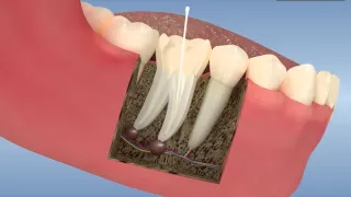 Root canal treatment and post core application