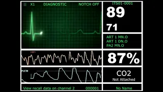 Hospital Monitor with FlatLine (L) (HD)