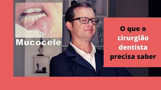 Mucocele. O que o cirurgião dentista precisa saber | Prof Mauricio Volkweis