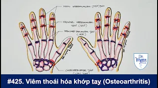 #425. Viêm thoái hóa khớp bàn tay (Hand Osteoarthritis) và cách phân biệt với viêm thấp khớp (RA)