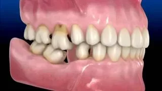 As conseqüências da perda de um dente.