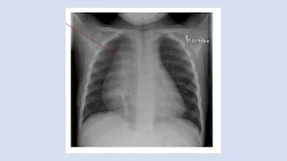 Introduction to Paediatric Oncology part 1