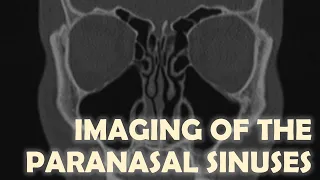 Imaging Anatomy of the Paranasal Sinuses