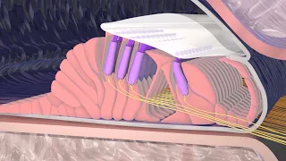 Hearing Loss Due to Nerve Damage