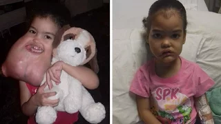 Toddler Finally Has Facial Tumour Removed