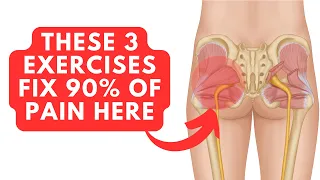 Fix 90% Of Piriformis & Glute Problems With These 3 Exercises