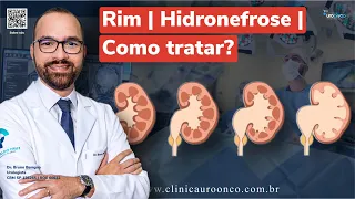 Hidronefrose: Um Problema Silencioso que pode afetar o Rim! Como Detectar, Prevenir e Tratar