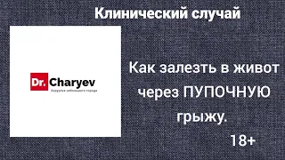 Клинический случай. Как залезть в живот, через Пупочную грыжу.