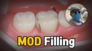 Dental Filling Procedure - MOD Molar Composite Restoration