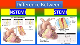 Contrast between   NSTEMI  and   STEMI