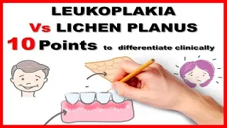 leukoplakia vs lichen planus : 10 points to differentiate clinically