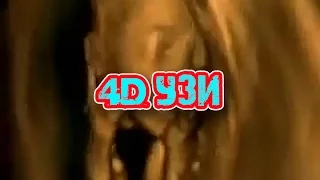 4D УЗИ