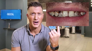 Dentist says DO NOT CROWN YOUR TEETH! - Proves it with a Clinical example!