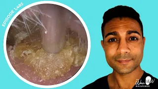 1,485 - Masses of Dead Skin Removed from Both Ears | Learn About Different Ear Wax Drops