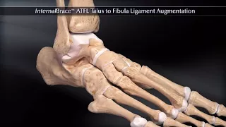 InternalBrace™ ATFL Talus to Fibula Ligament Augmentation