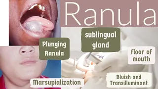 Ranula|General Surgery for Dental Students|Bibliodent