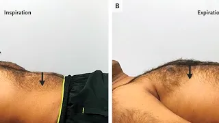 Paradoxical Abdominal Movement and Diaphragmatic Paralysis with Paradoxical Abdominal Movement