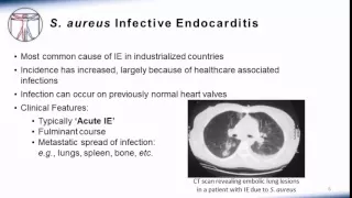 Endocarditis: Microbiology and Treatment