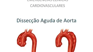 Dissecção Aguda de Aorta | Videoaula - 02/06/2020