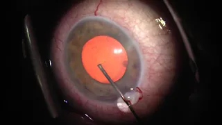 cornea edema, blood in AC, diab. mel, PEX phacotrabectome