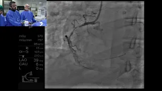 Endoluminal reconstruction of a diffusely diseased and tortuous RCA by Tejas Patel