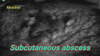 Subcutaneous abscess.