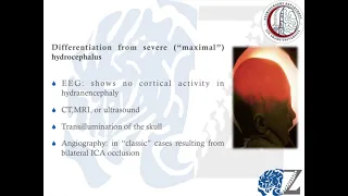 Hydranencephaly استسقاء الرأس