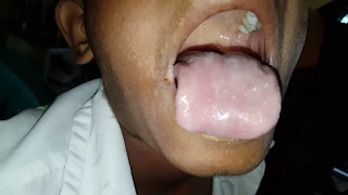 Muller's sign is the pulsation or bobbing of the uvula in Severe AR in RHD child