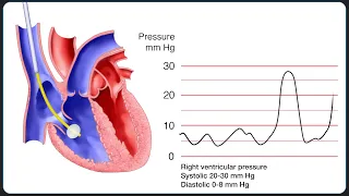 Insertion of a Pulmonary Artery (Swan-Ganz) Catheter