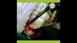 Simple Mandibular Wisdom Tooth Extraction