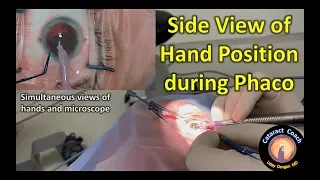 Side View of Hand Position during Phaco Chop Cataract Surgery