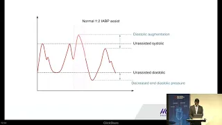 Raviteja Guddeti, MD | Mechanical Circulatory Support in the Cath Lab: Where Are We Now?