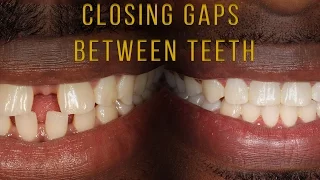 Closing Gaps Between Teeth With Braces