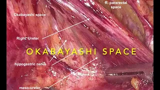 Laparoscopic demonstration of the Okabayashi Space by Prof. N. Vlahos & Dr. I. Biliatis