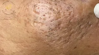 Acne Treament Under The Skin #029