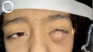 Ophthalmic Signs Eyelids