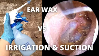 Water Irrigation And Suction Used To Clear Ear Wax