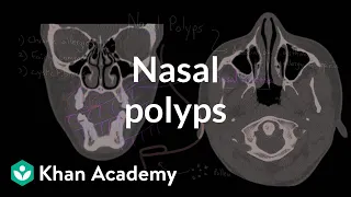 Nasal polyps | Respiratory system diseases | NCLEX-RN | Khan Academy