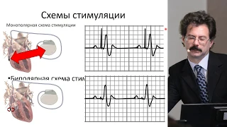 Часть 1. "Холтеровское мониторирование пациентов со стимулятором"