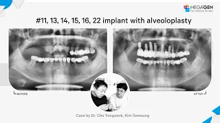 Dr. Yongseok CHO, Sewoung KIM, #11,13,14,15,16,22 implant with alveoloplasty