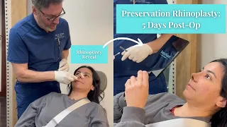 Preservation Rhinoplasty: 5 Days Post-Op