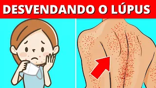 Lúpus: Mistério Revelado! Os Segredos e os Sintomas Desta Doença! | Saúde e Equilíbrio