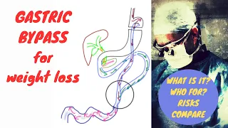 Gastric Bypass | Roux en Y Gastric Bypass | RYGB