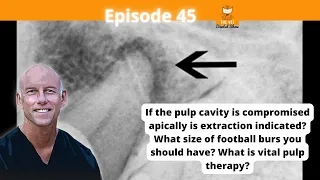 Ep 45 - If the pulp cavity is compromised apically is extraction indicated?